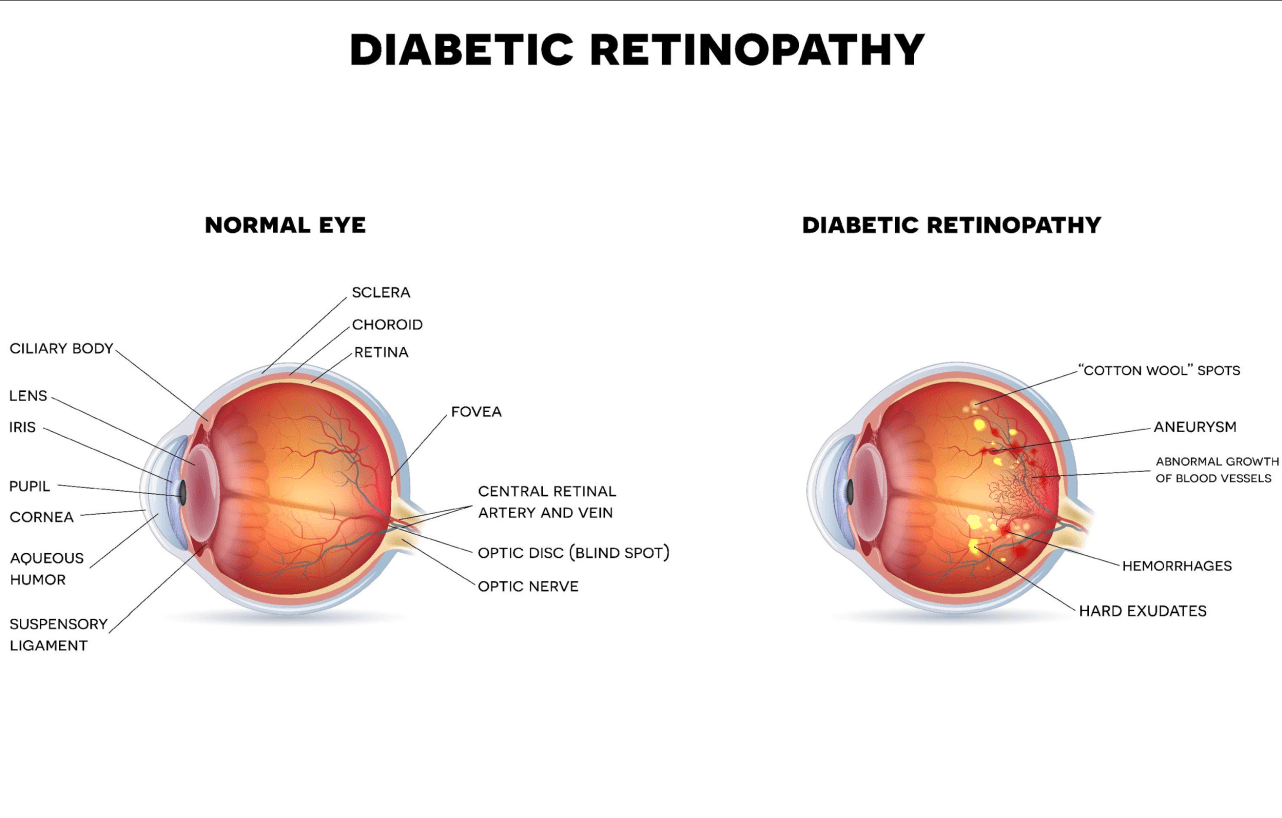 Diabetic Retinopathy Rochester, PA