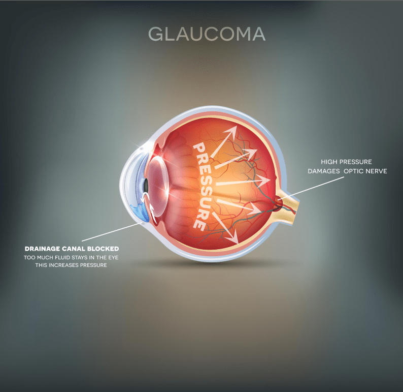 Glaucoma Rochester, PA